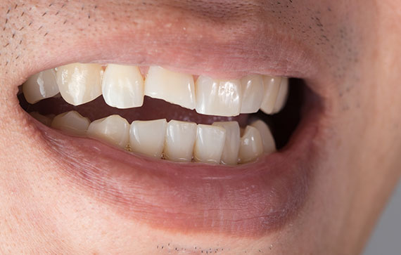 Porcelain Veneers