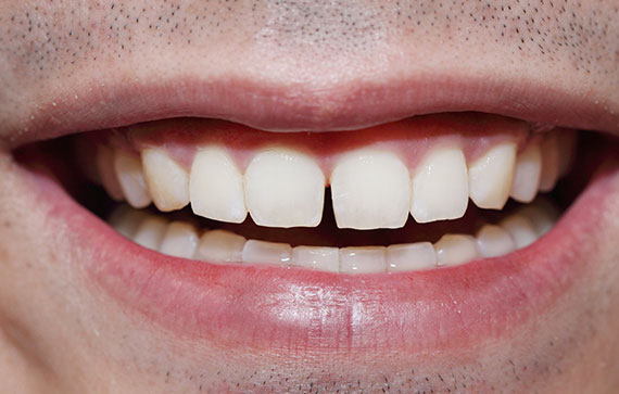 Porcelain Veneers