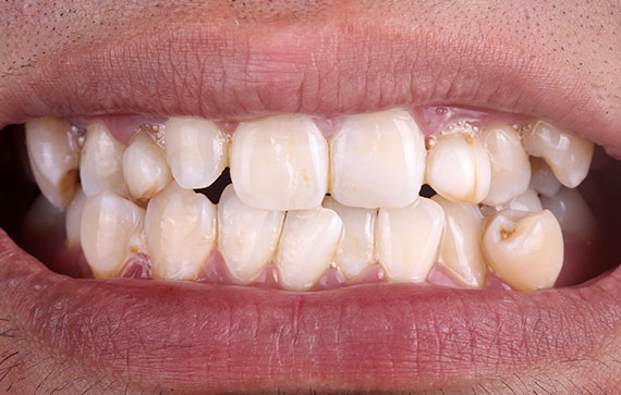 Porcelain Veneers