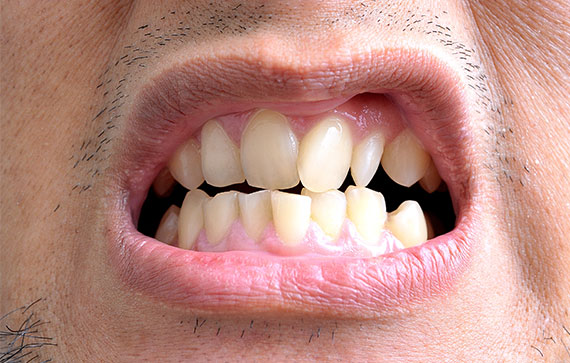 Porcelain Veneers