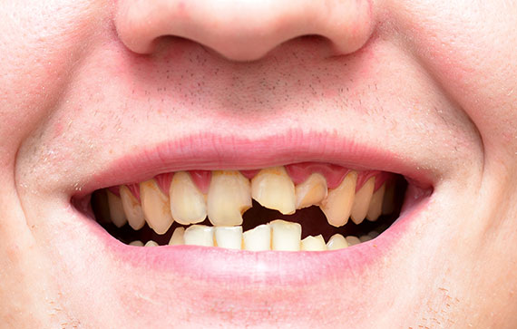 Porcelain Veneers