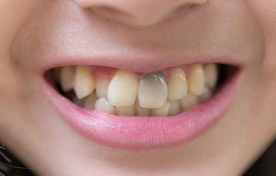 Porcelain Veneers
