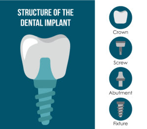 Why Are Dental Implants So Popular